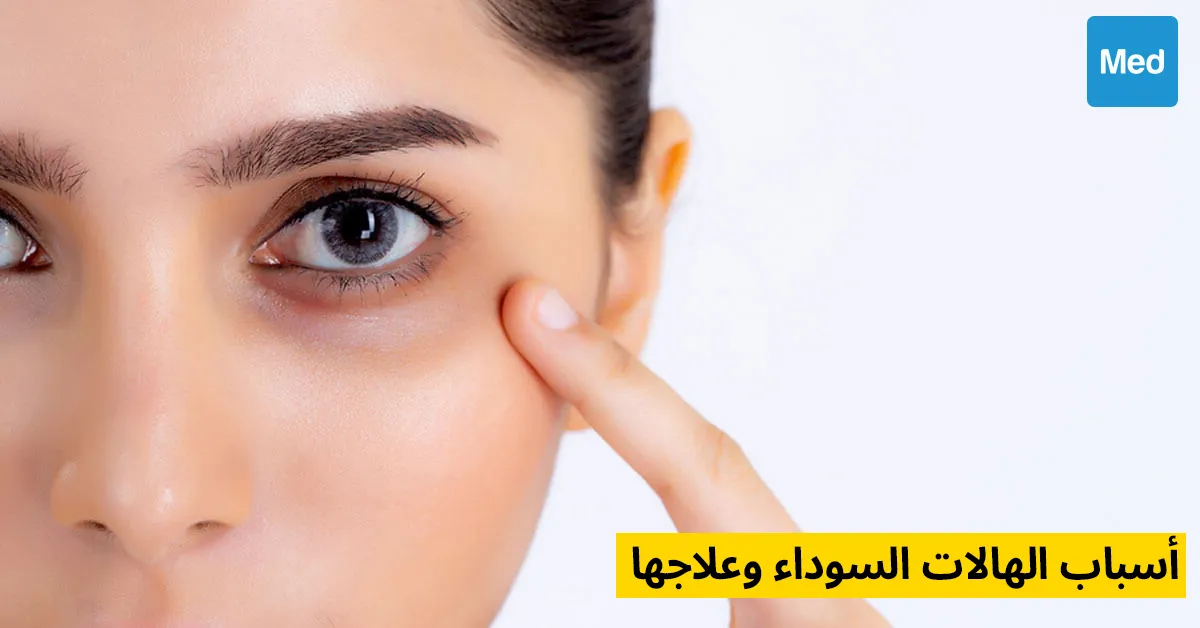 أسباب الهالات السوداء وعلاجها